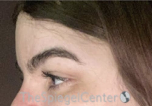 Forehead Contouring Before & After Gallery - Patient 189184 - Image 4