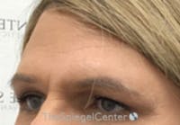 FFS Forehead Contouring Before & After Gallery - Patient 258503 - Image 1