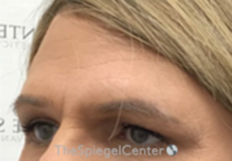 FFS Forehead Contouring Before & After Gallery - Patient 258503 - Image 1