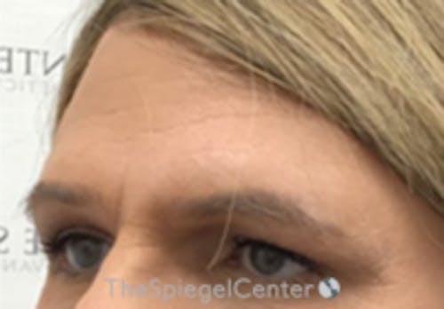 Forehead Contouring Before & After Gallery - Patient 161085 - Image 1