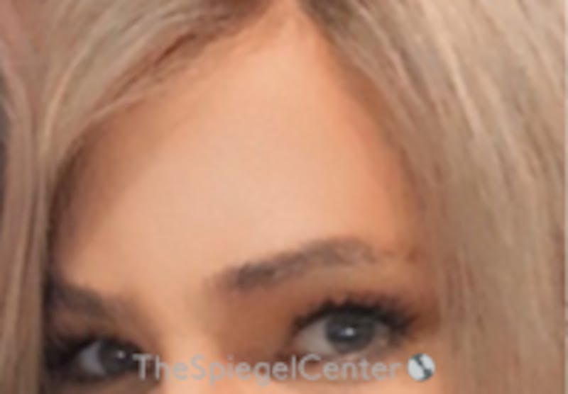 FFS Forehead Contouring Before & After Gallery - Patient 258503 - Image 2