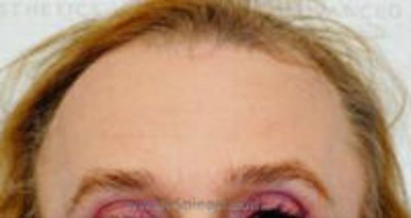 Forehead Contouring Before & After Gallery - Patient 817483 - Image 1