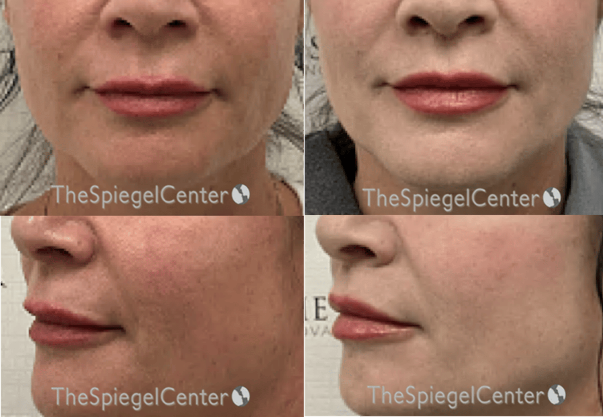Lip Lift Before & After Gallery - Patient 340080 - Image 1