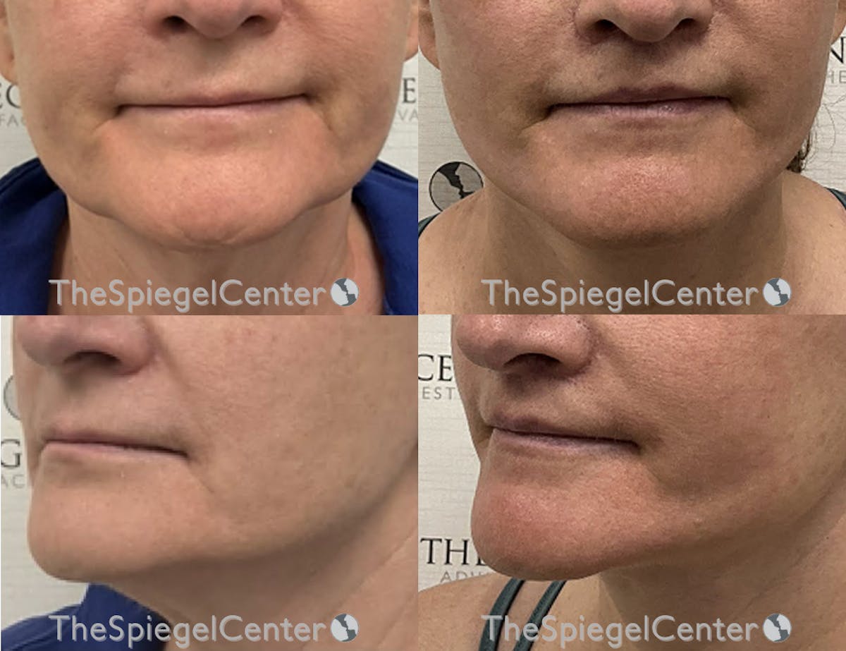 Lip Lift Before & After Gallery - Patient 293789 - Image 1