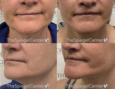 Lip Lift Before & After Gallery - Patient 293789 - Image 1