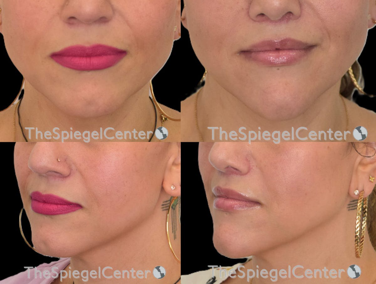 Lip Lift Before & After Gallery - Patient 253546 - Image 1