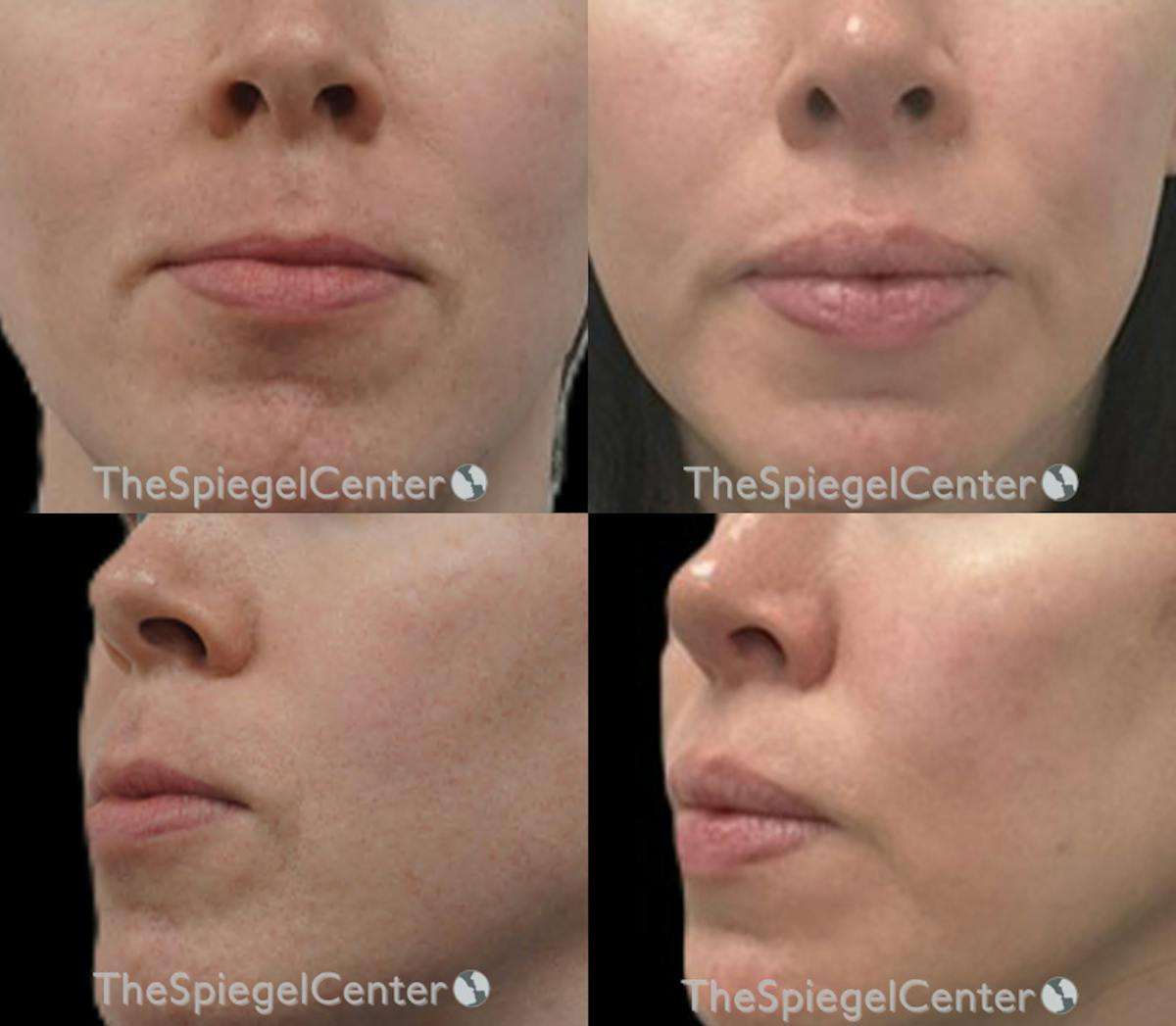 Lip Lift Before & After Gallery - Patient 157366 - Image 1