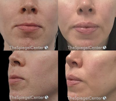 Lip Lift Before & After Gallery - Patient 157366 - Image 1