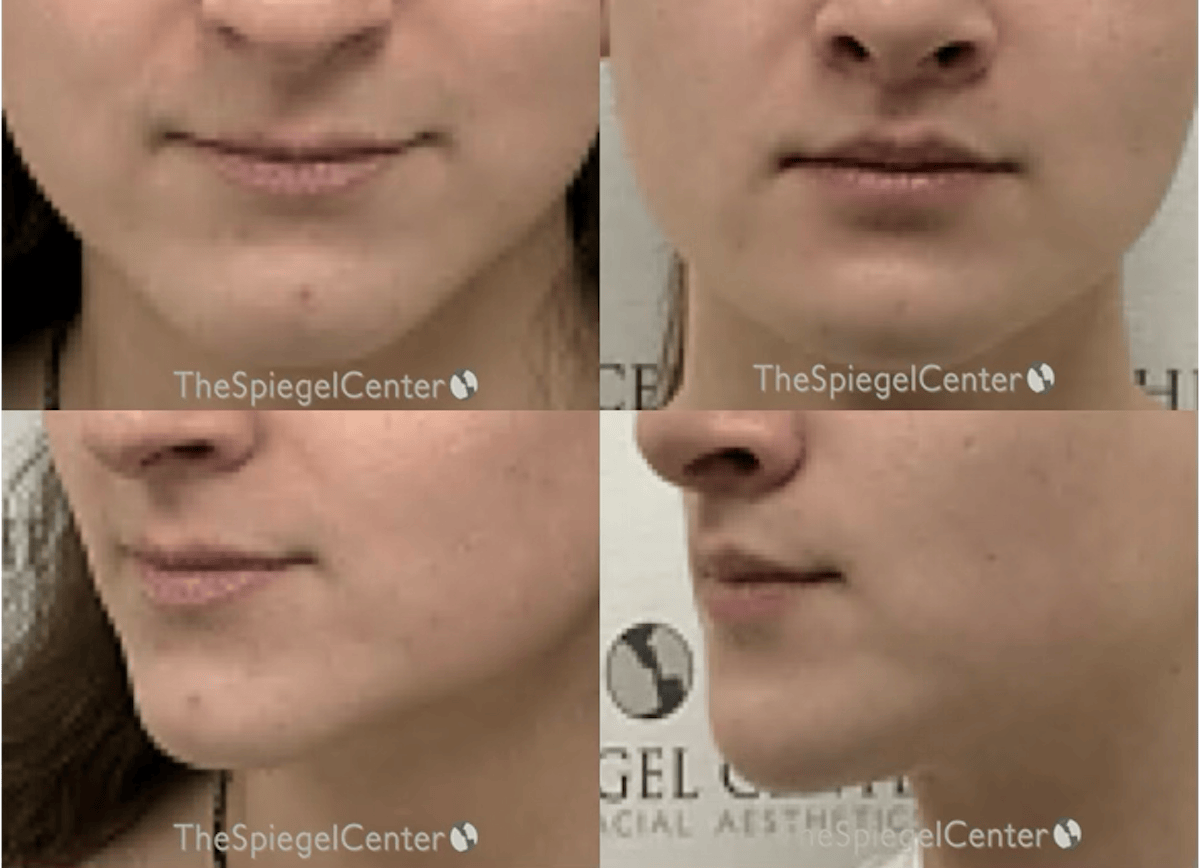 Lip Lift Before & After Gallery - Patient 104112 - Image 1