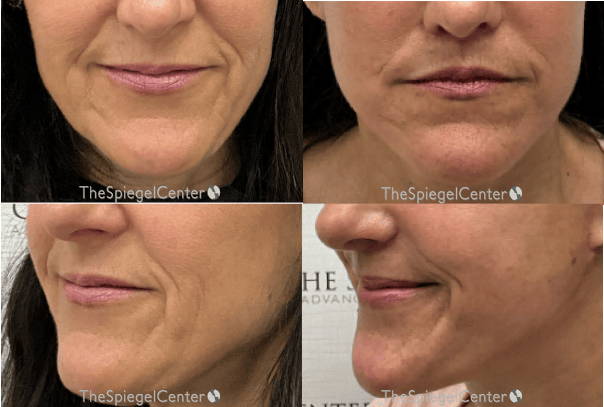 Lip Lift Before & After Gallery - Patient 106827 - Image 1