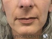Lip Lift Before & After Gallery - Patient 350388 - Image 1
