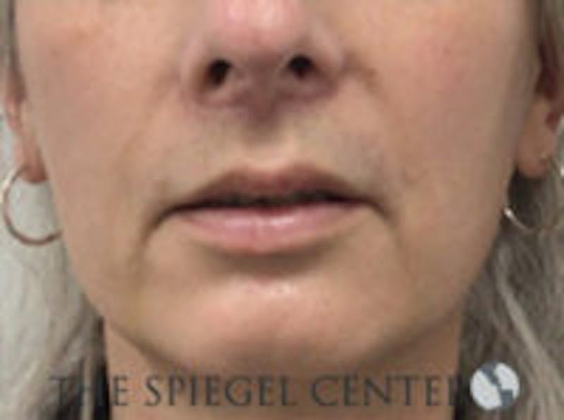 Lip Lift Before & After Gallery - Patient 350388 - Image 2