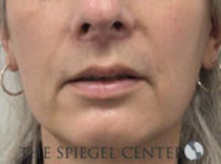 Lip Lift Before & After Gallery - Patient 350388 - Image 2