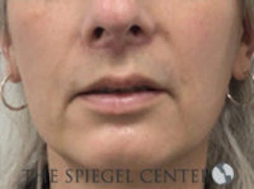 Lip Lift Before & After Gallery - Patient 350388 - Image 2