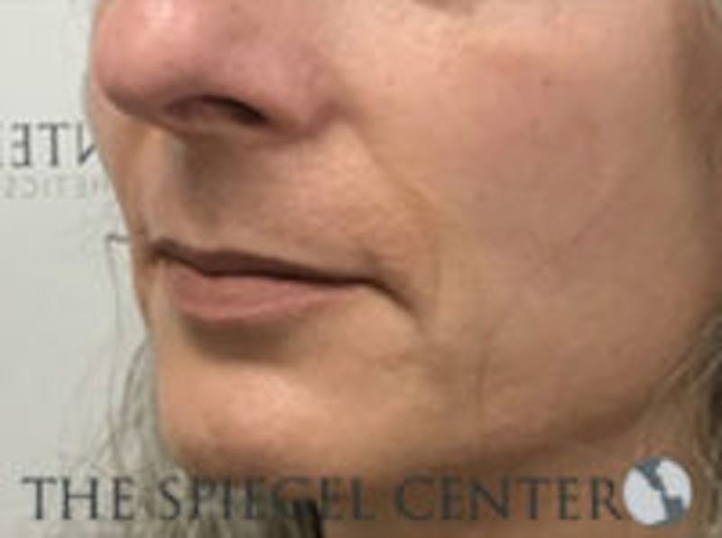 Lip Lift Before & After Gallery - Patient 350388 - Image 3