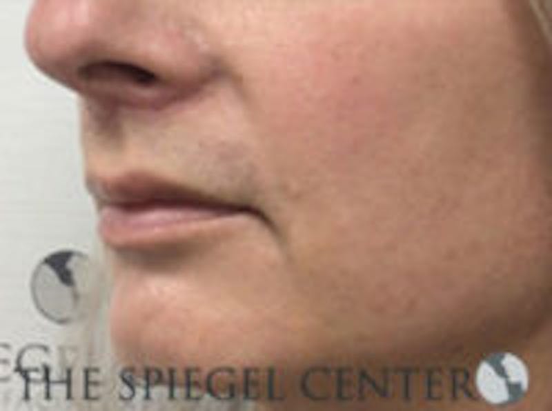 Lip Lift Before & After Gallery - Patient 350388 - Image 4