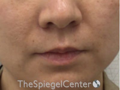 Lip Lift Before & After Gallery - Patient 326346 - Image 1