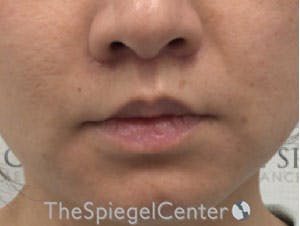 Lip Lift Before & After Gallery - Patient 326346 - Image 2
