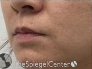 Lip Lift Before & After Gallery - Patient 326346 - Image 3