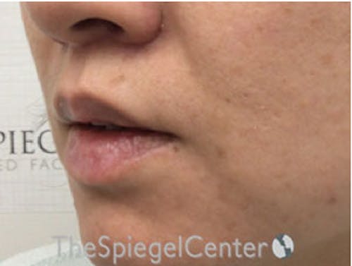 Lip Lift Before & After Gallery - Patient 326346 - Image 4