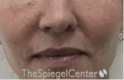 Lip Lift Before & After Gallery - Patient 332579 - Image 1