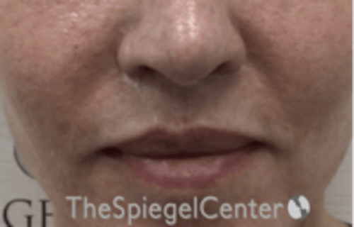 Lip Lift Before & After Gallery - Patient 332579 - Image 2