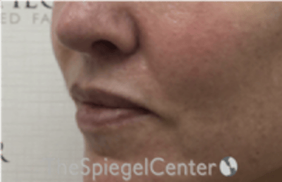 Lip Lift Before & After Gallery - Patient 332579 - Image 3