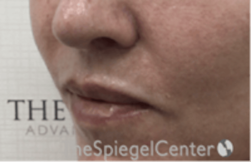 Lip Lift Before & After Gallery - Patient 332579 - Image 4
