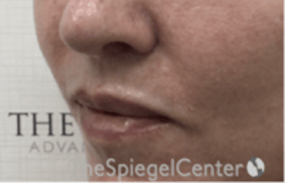 Lip Lift Before & After Gallery - Patient 332579 - Image 4