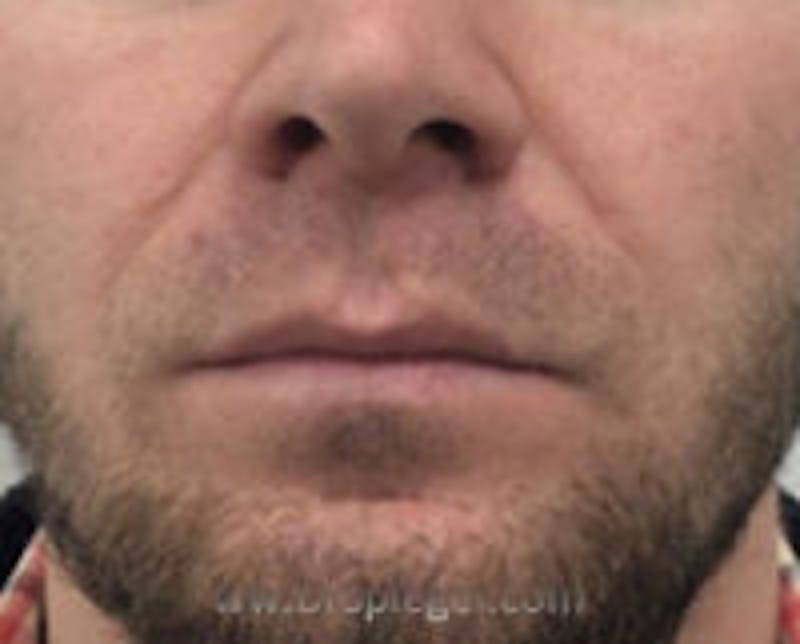Lip Lift Before & After Gallery - Patient 338137 - Image 1