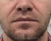 Lip Lift Before & After Gallery - Patient 338137 - Image 2