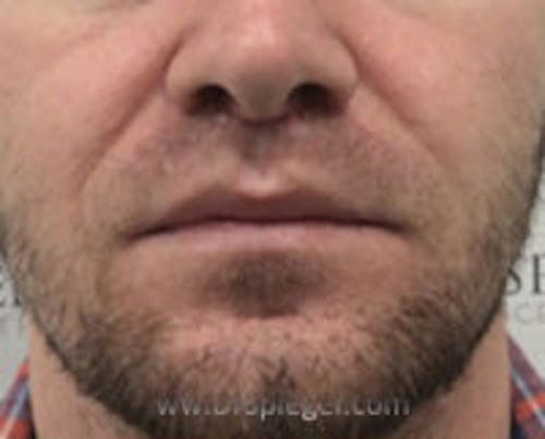 Lip Lift Before & After Gallery - Patient 338137 - Image 2