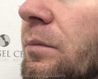 Lip Lift Before & After Gallery - Patient 338137 - Image 3