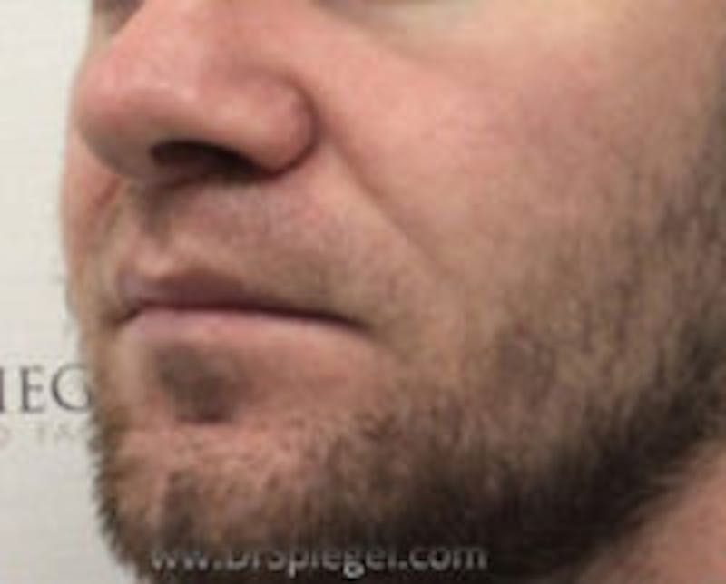Lip Lift Before & After Gallery - Patient 338137 - Image 4