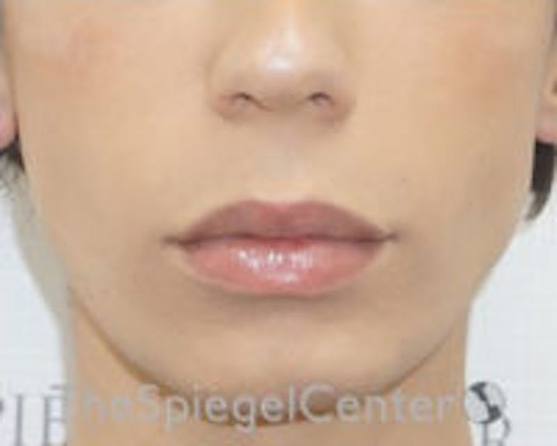 Lip Lift Before & After Gallery - Patient 438716 - Image 1