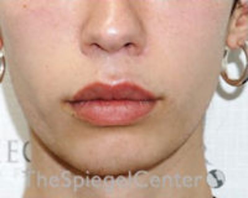 Lip Lift Before & After Gallery - Patient 438716 - Image 2