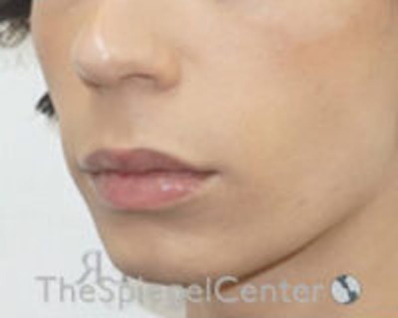 Lip Lift Before & After Gallery - Patient 438716 - Image 3