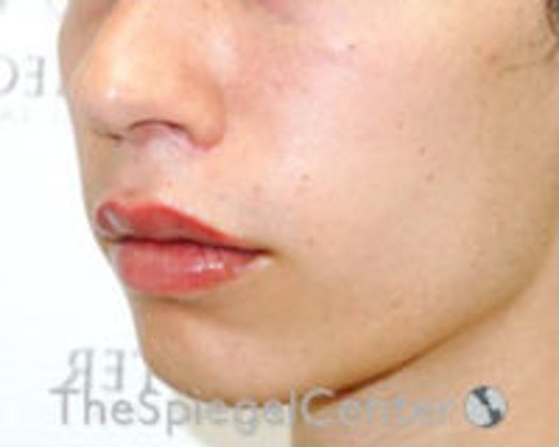Lip Lift Before & After Gallery - Patient 438716 - Image 4