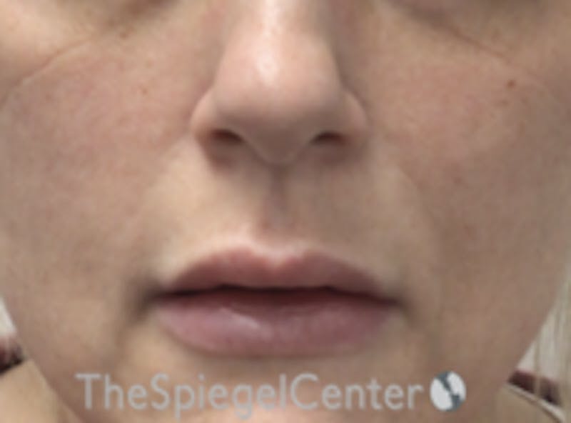 Lip Lift Before & After Gallery - Patient 157151 - Image 1
