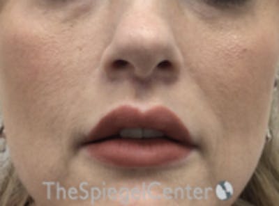Lip Lift Before & After Gallery - Patient 157151 - Image 2