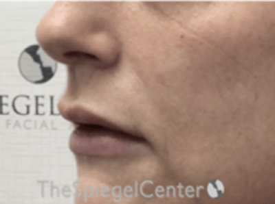 Lip Lift Before & After Gallery - Patient 157151 - Image 3