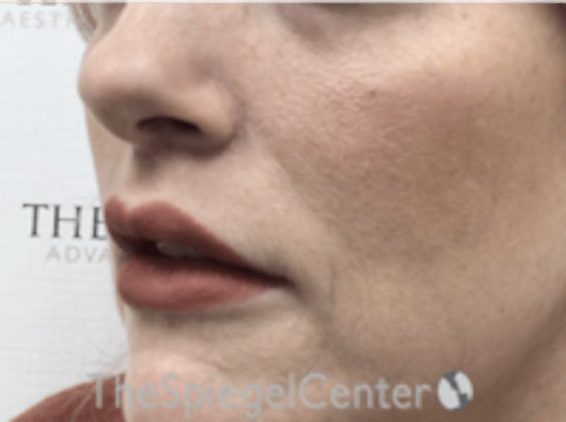Lip Lift Before & After Gallery - Patient 157151 - Image 4
