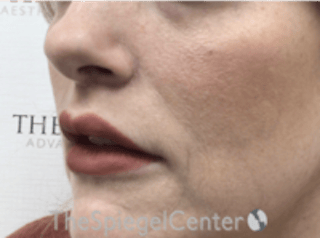Lip Lift Before & After Gallery - Patient 157151 - Image 4