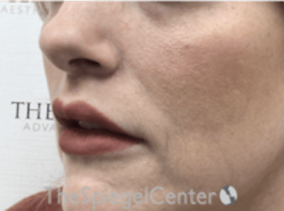 Lip Lift Before & After Gallery - Patient 157151 - Image 4