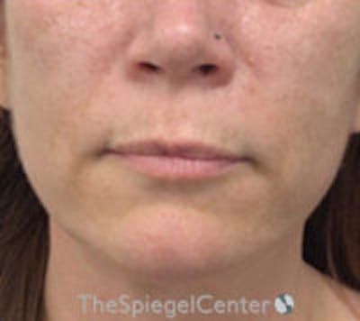 Lip Lift Before & After Gallery - Patient 898186 - Image 1