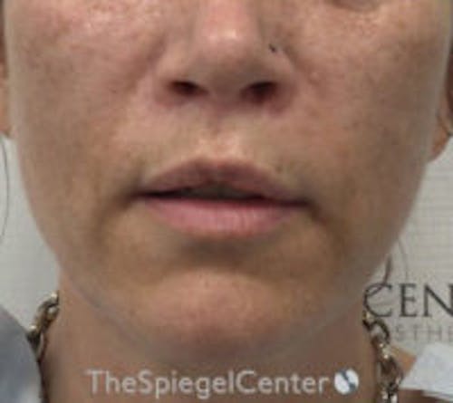 Lip Lift Before & After Gallery - Patient 898186 - Image 2