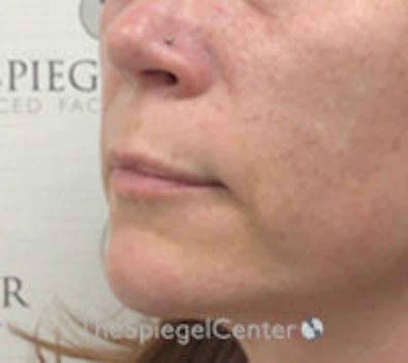 Lip Lift Before & After Gallery - Patient 898186 - Image 3