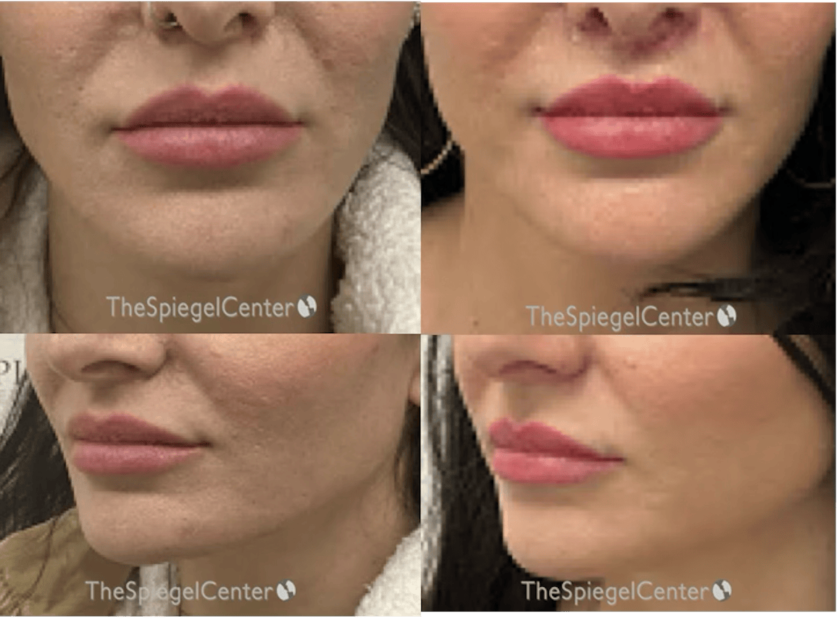 Lip Lift Before & After Gallery - Patient 324614 - Image 1