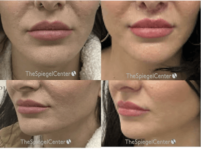 Lip Lift Before & After Gallery - Patient 324614 - Image 1