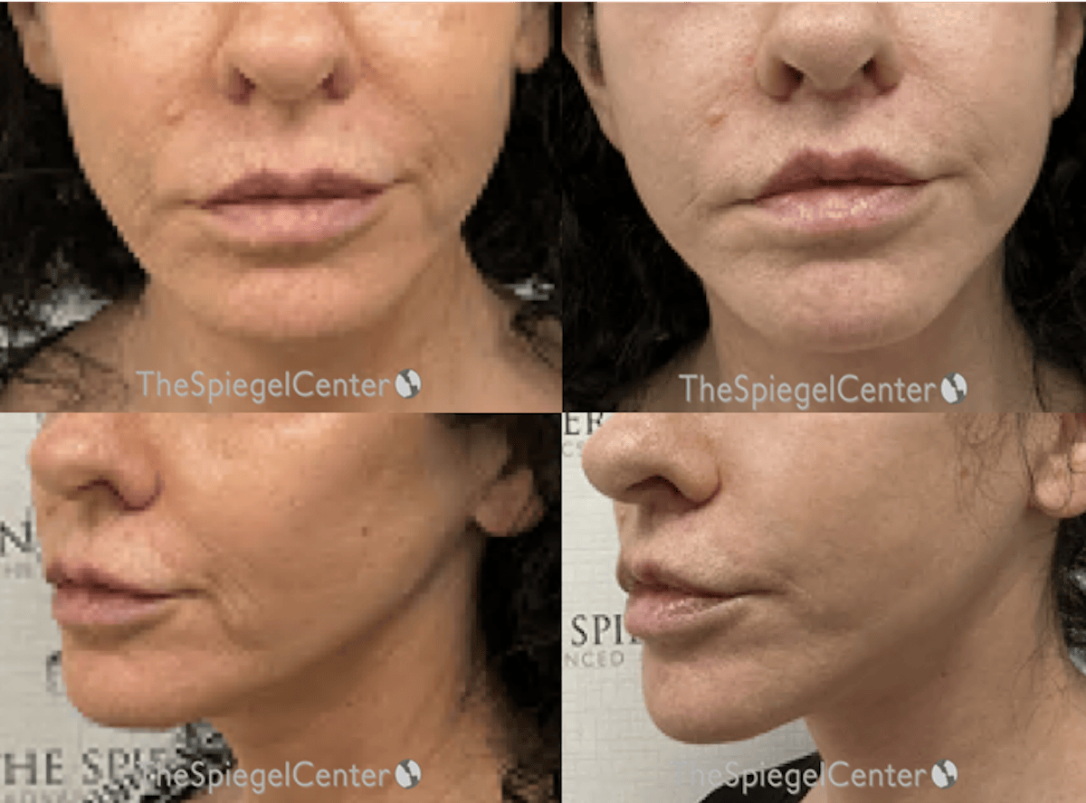 Lip Lift Before & After Gallery - Patient 215336 - Image 1